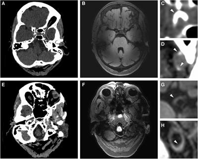 Imaging of intracranial arterial disease: a comparison between MRI and unenhanced CT